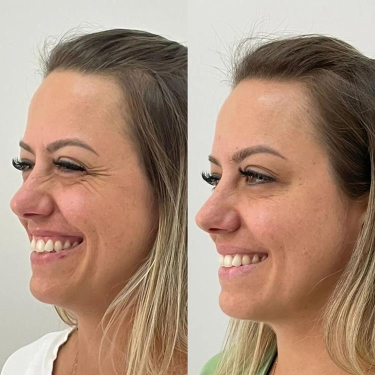 Resultado Toxina Full Face